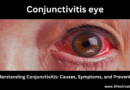 Understanding Conjunctivitis: Causes, Symptoms, and Prevention